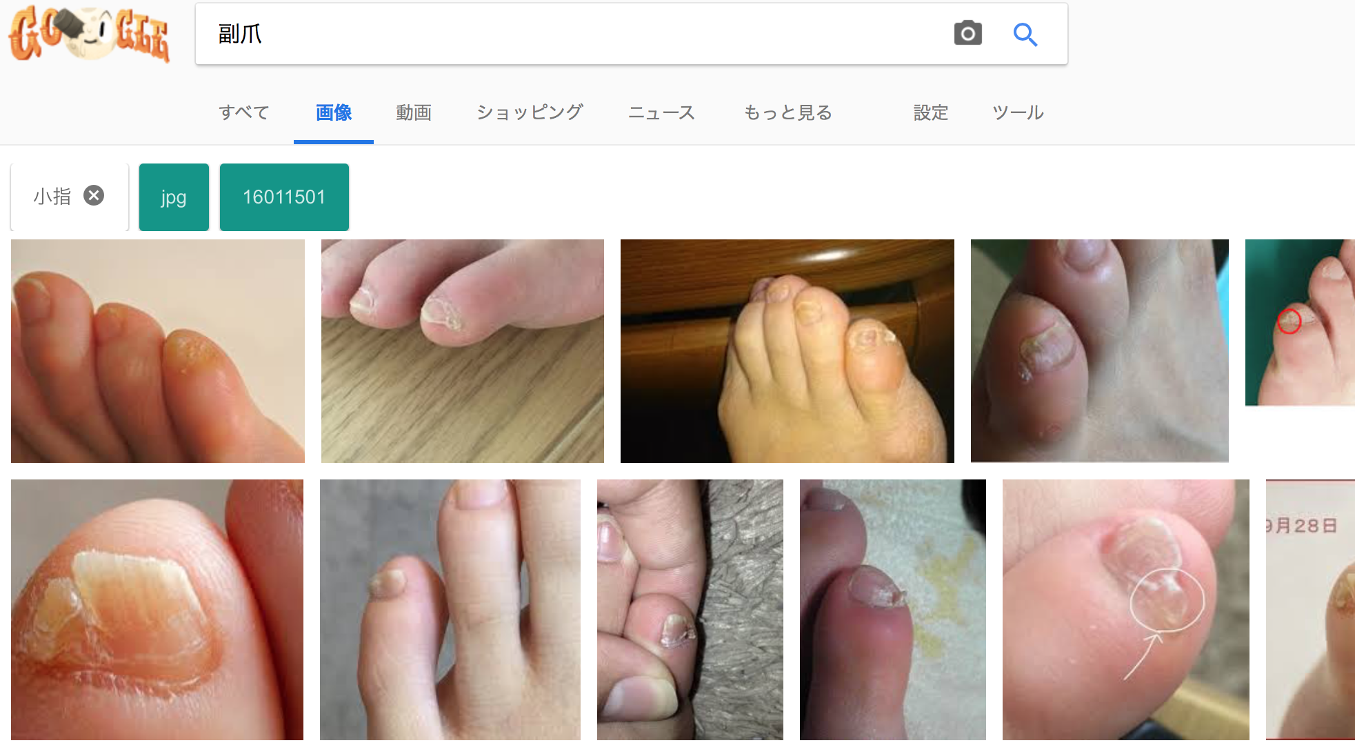 足の小指の爪が小さいのは遺伝 病気 深爪 原因 治し方 ケア方法
