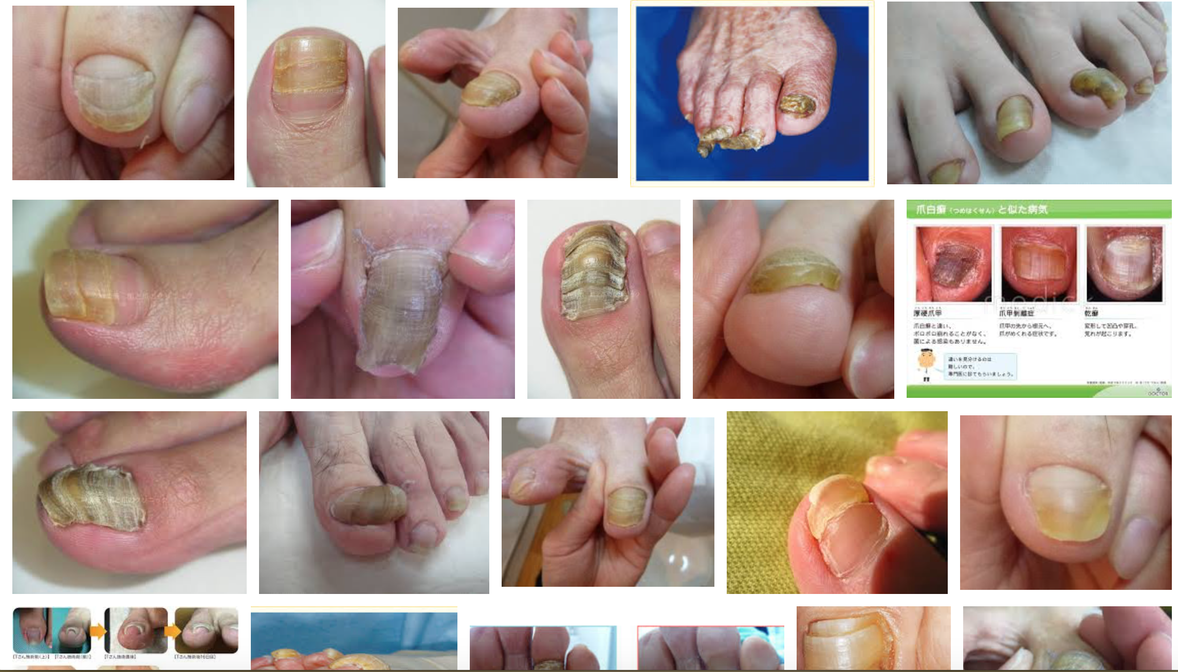 足の小指の爪が割れる 崩れて汚い 厚い 原因と対策紹介 意外にも甘皮や角質が