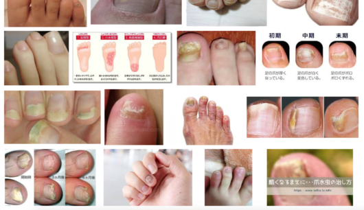 足の小指の爪が割れる 崩れて汚い 厚い 原因と対策紹介 意外にも甘皮や角質が